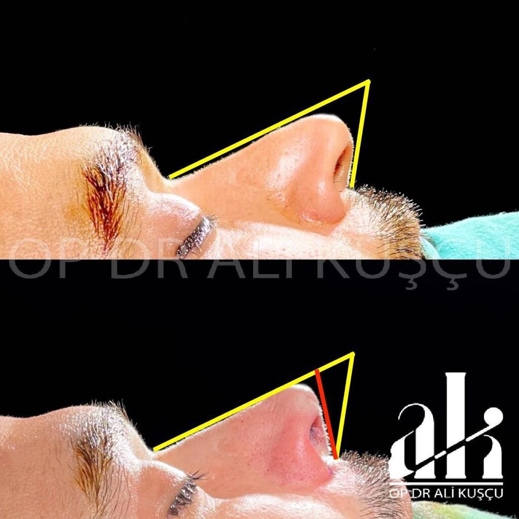burun-estetigi-oncesisonrası (1)