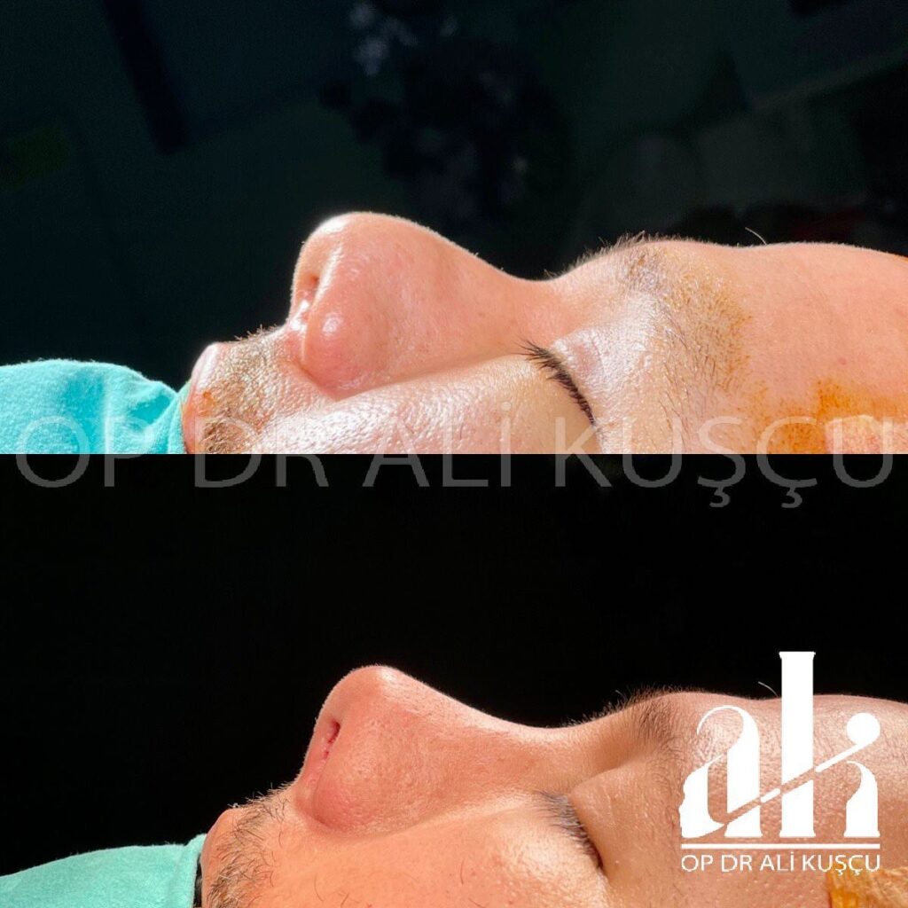 burun-estetigi-oncesisonrası (10)