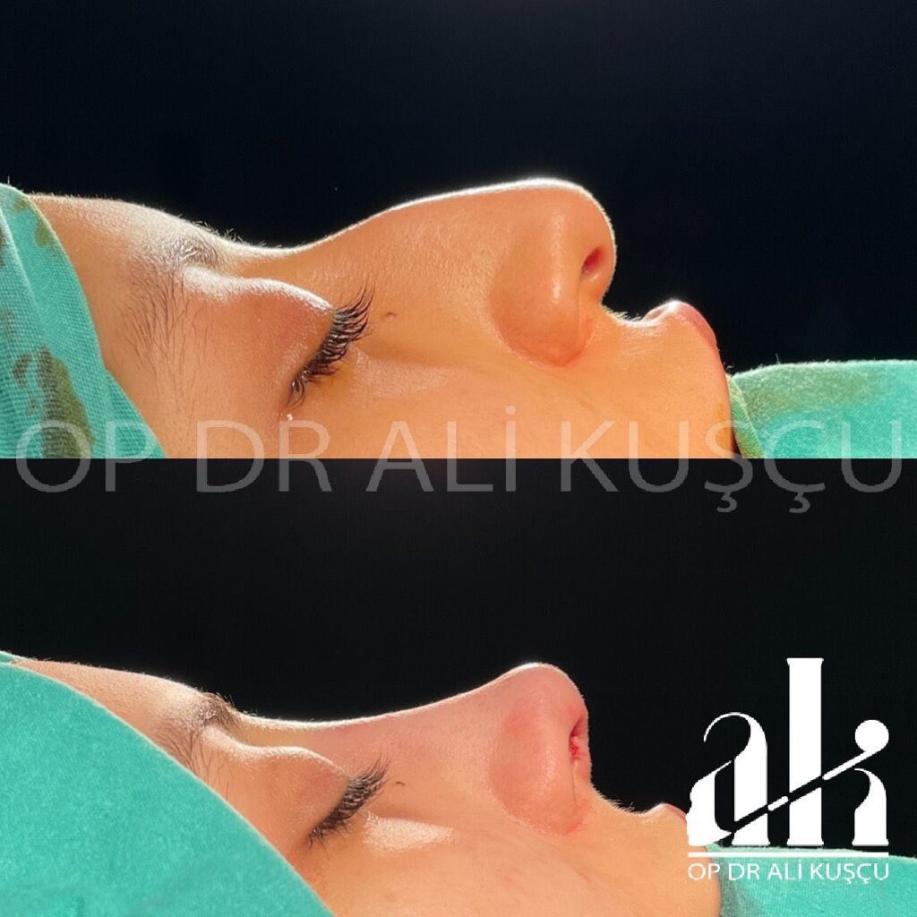 burun-estetigi-oncesisonrası (2)