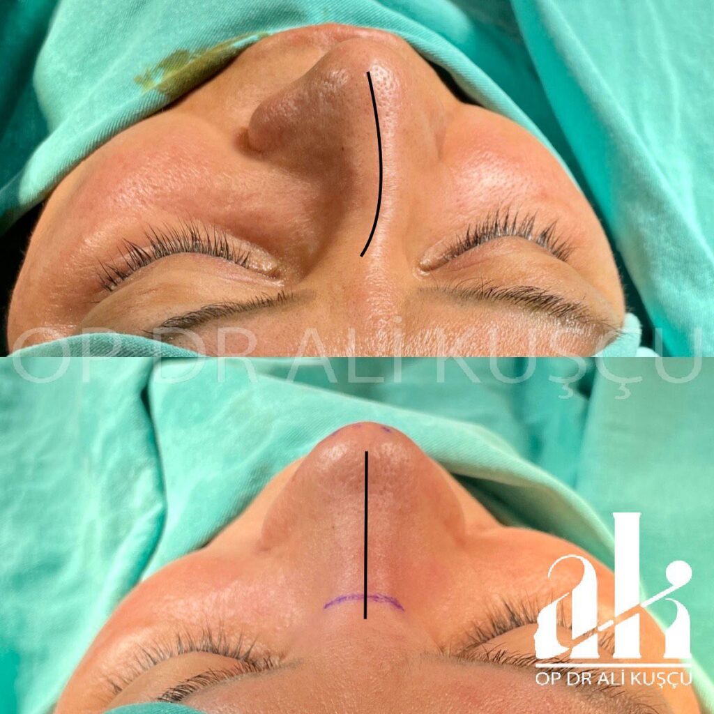 burun-estetigi-oncesisonrası (3)