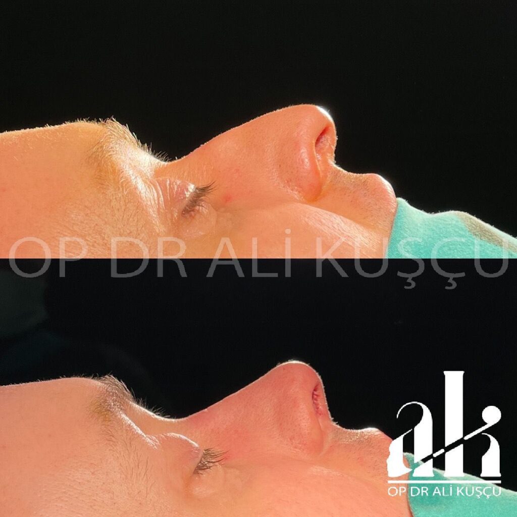 burun-estetigi-oncesisonrası (4)