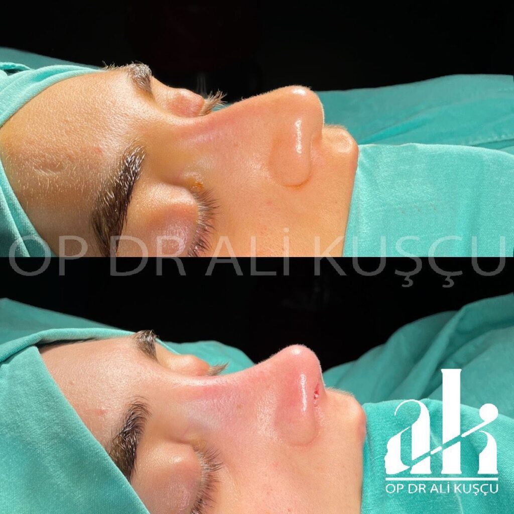 burun-estetigi-oncesisonrası (5)
