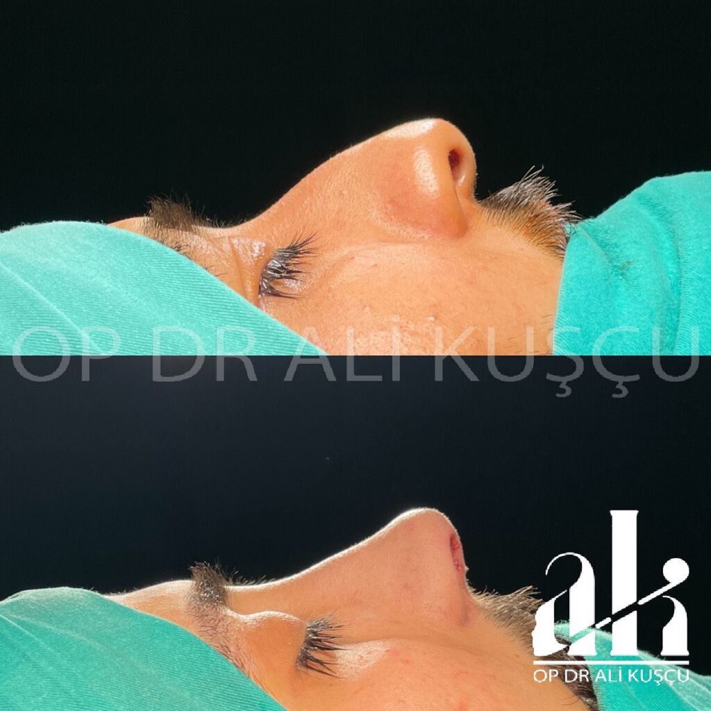burun-estetigi-oncesisonrası (6)