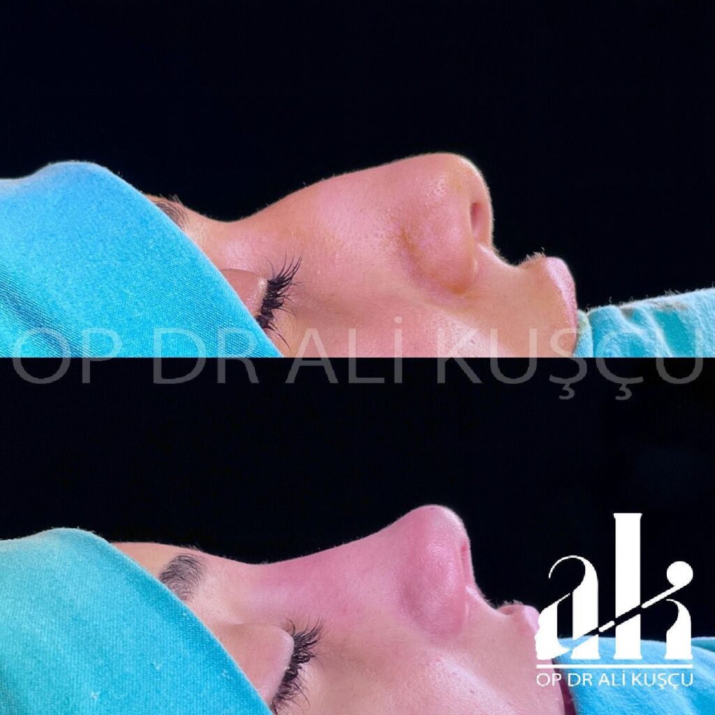 burun-estetigi-oncesisonrası (7)