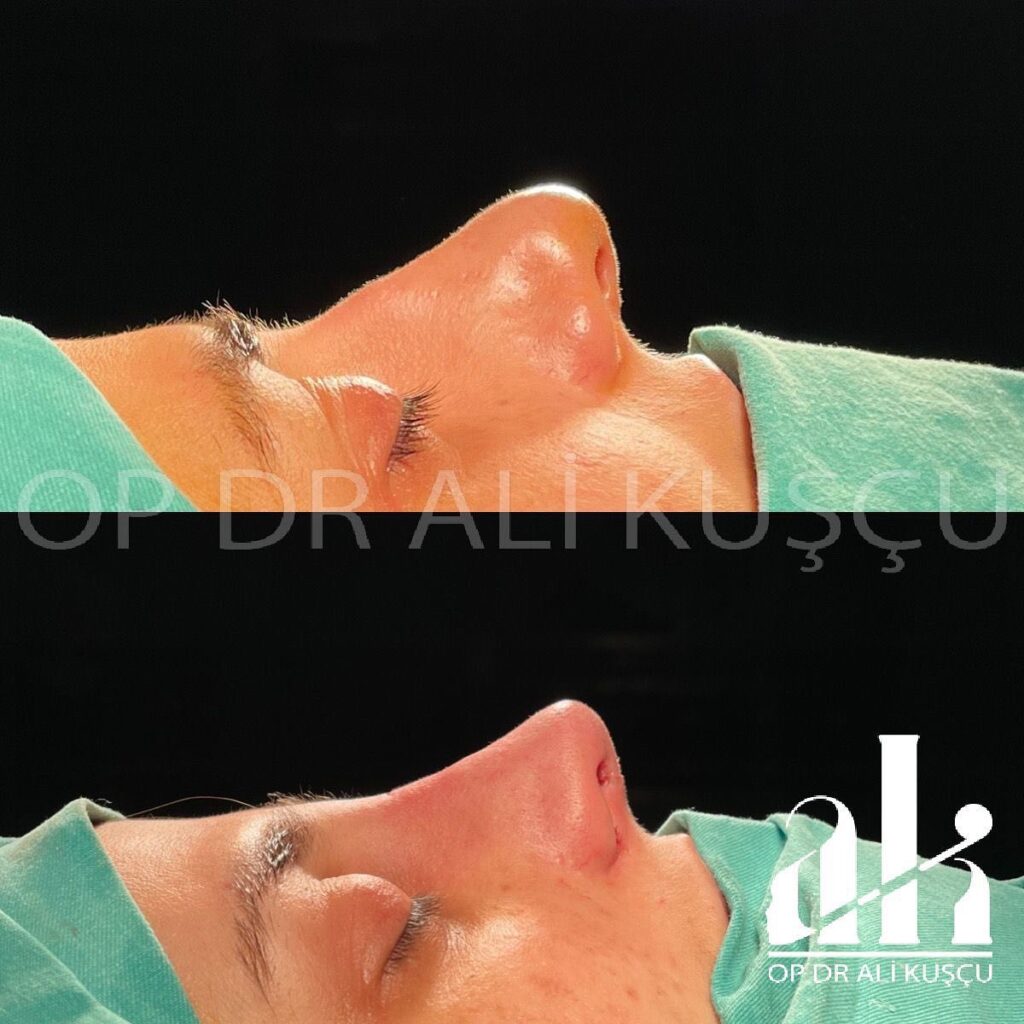 burun-estetigi-oncesisonrası (8)