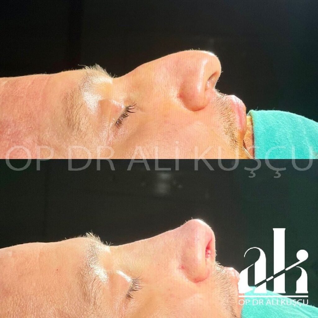 burun-estetigi-oncesisonrası (9)
